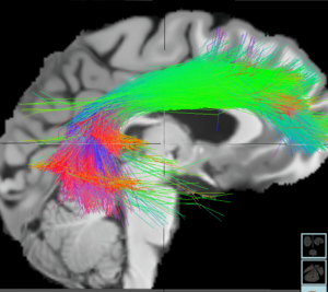 Encender y apagar el cerebro