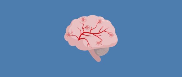 ACV-Ictus-NeuroClass.