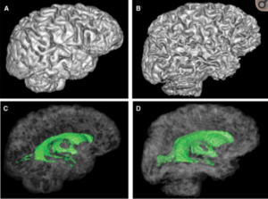 Imagen obtenida de: Sullivan, E. V.  y Pfefferbaum, A. (2009). Neuroimaging of the Wernicke-Korsakoff Syndrome. Alcohol and Alcoholism, 44(2), 155-165. https://doi.org/10.1093/alcalc/agn103
