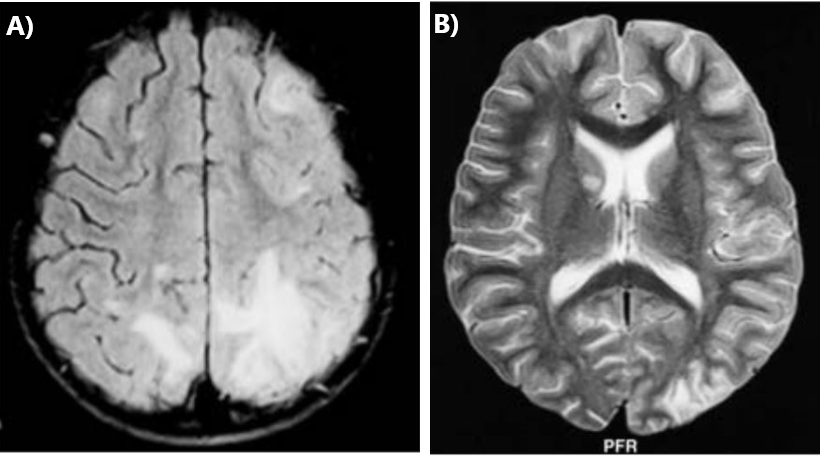 Púrpura de Henoch-Schönlein