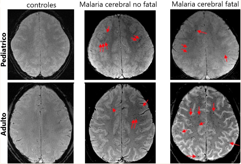 Malaria cerebral. Efectos de la malaria