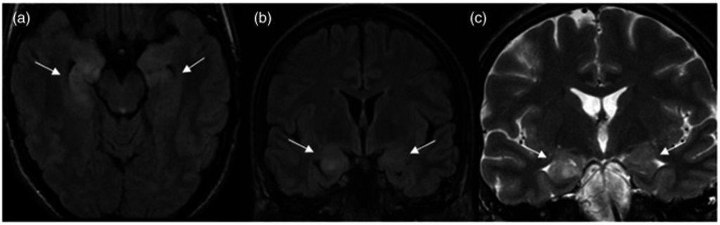 Encefalitis: ¿Qué ocurre a nivel neuropsicológico?