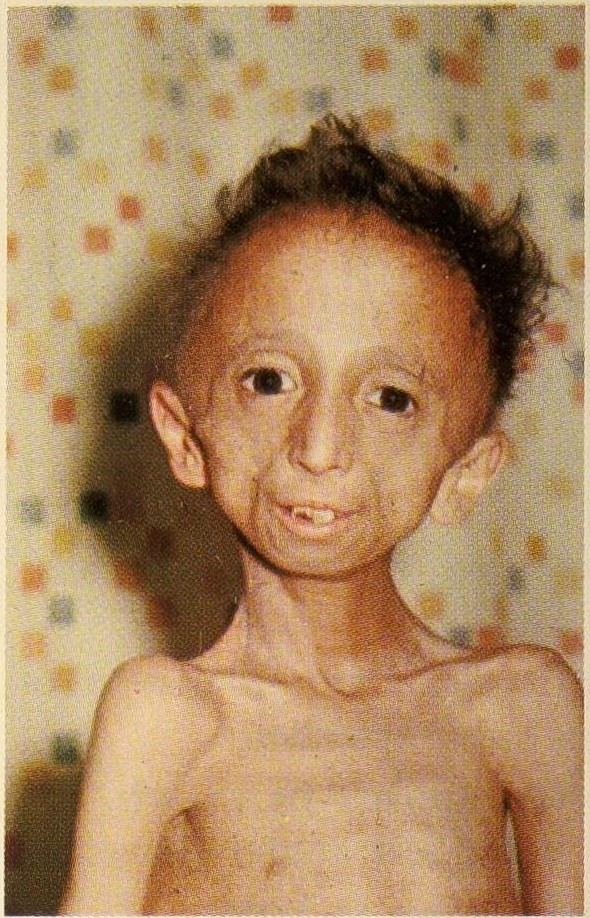 progeria