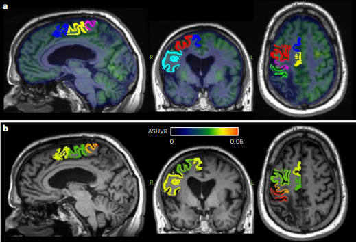 estimulación cerebral profunda, recuperar la motricidad tras un ACV