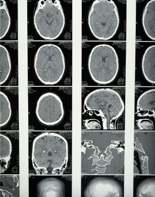 alteraciones cerebrales