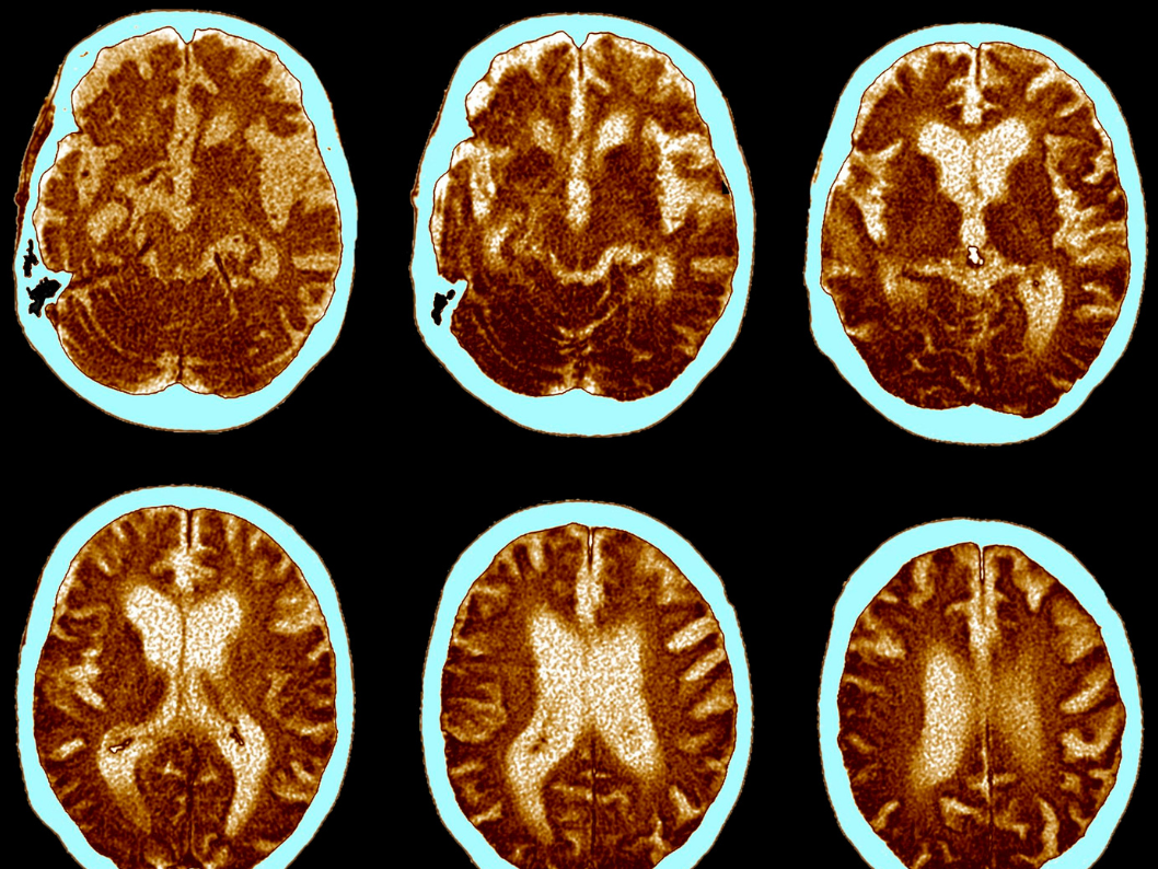 Estrés crónico y Alzheimer 