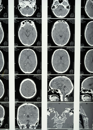 negligencia espacial unilateral