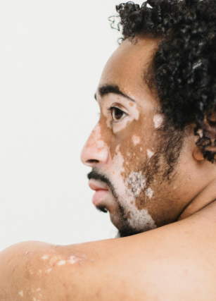 Vitiligo