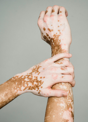 Vitiligo y ansiedad